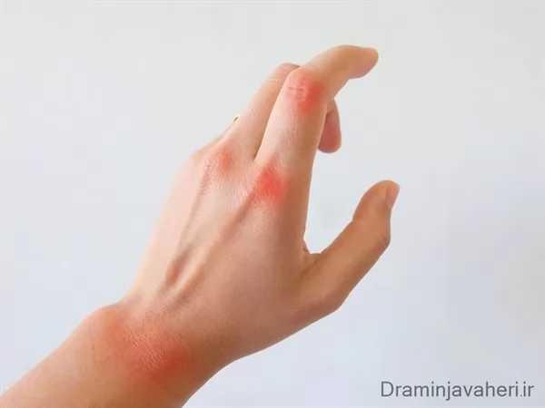 درد انگشتان به دنبال آرتریت روماتوئید در جوانان