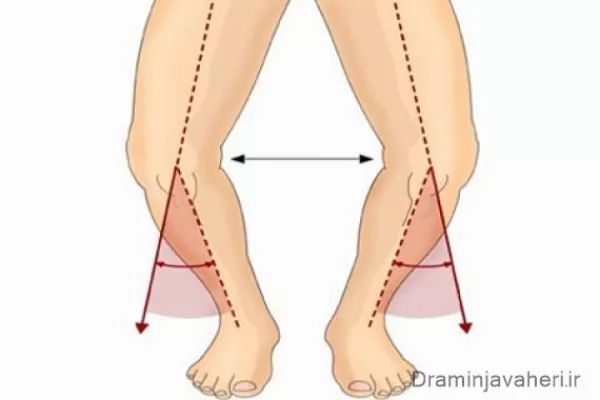 تشخیص پای پرانتزی