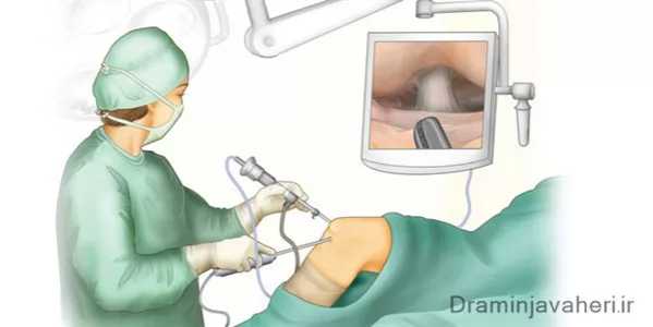 درمان بوریست زانو با جراحی آرتروسکوپی