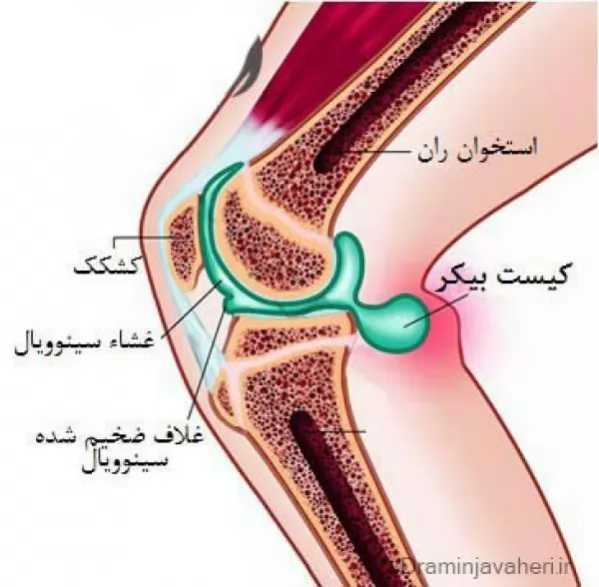 درد پشت زانو به دنبال کیست بیکر