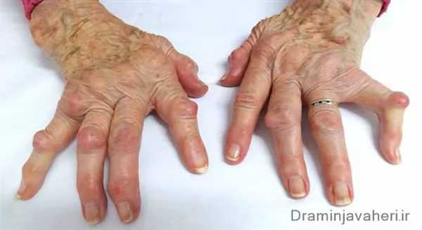 التهاب مفاصل در انگشتان