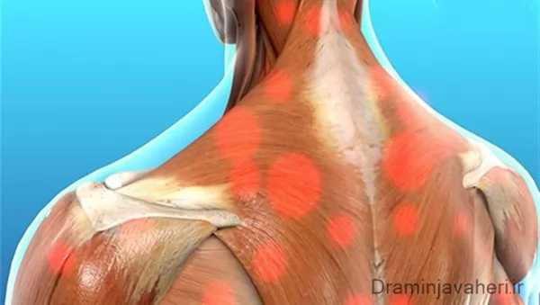 درد عضلانی ناحیه پشتی
