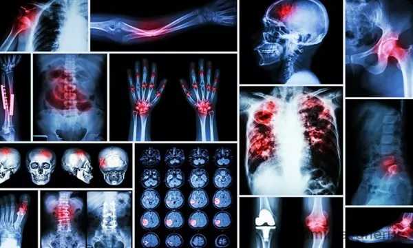 تشخیص سرطان استخوان با عکس رادیوگرافی